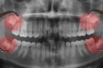 X-rays of impacted wisdom teeth before extraction