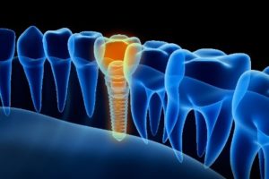 digital image of dental implants