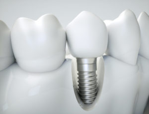 Dental implant