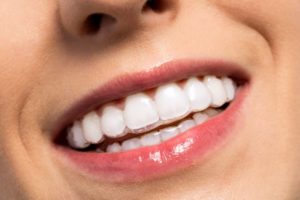 woman smiling wearing clear braces