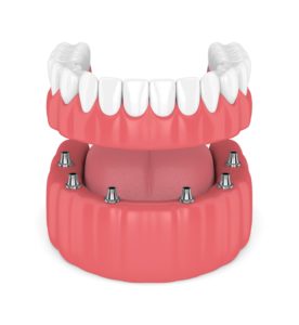 implant-retained denture