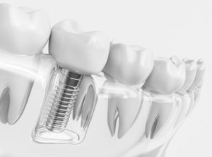 dental implant