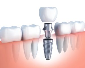 dental implant in Columbia