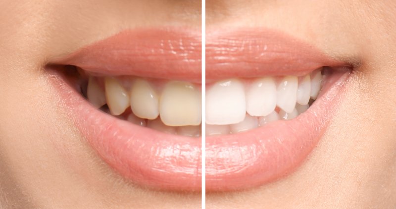 Teeth whitening in Columbia