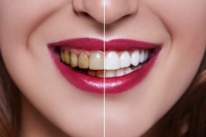 Before and after teeth whitening in Columbia
