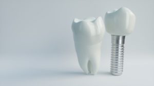 dental implant in Columbia next to natural tooth 