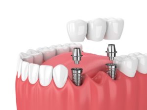 dental bridge supported by two dental implants in Columbia 