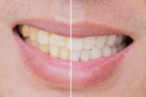 a stained smile before and after whitening