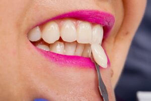 Close up of veneer next to woman’s teeth