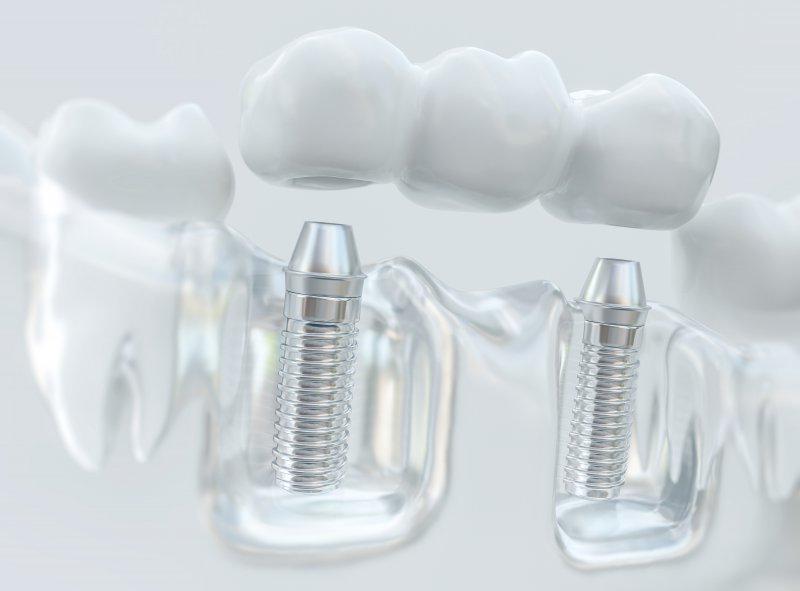 Model of implant bridge