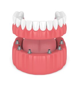 Model of implant-supported lower denture