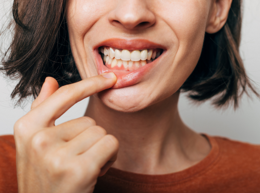 Woman pulling lip down to show gums