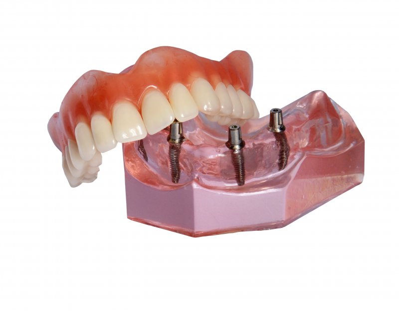 Model of All-on-4 dentures