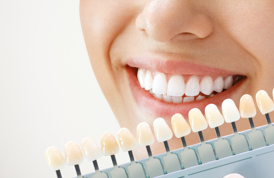 Smile with different whitening shade options