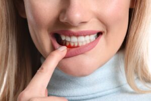 Woman showing redness in bottom gums.