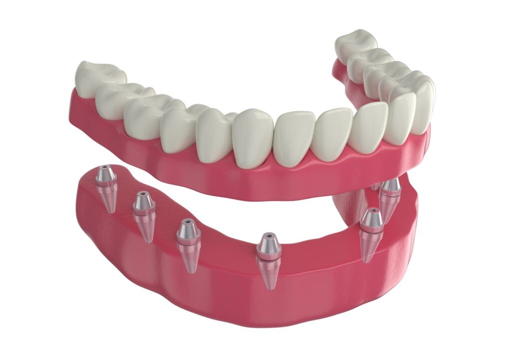 A CGI of how an implant denture attaches to the jaw
